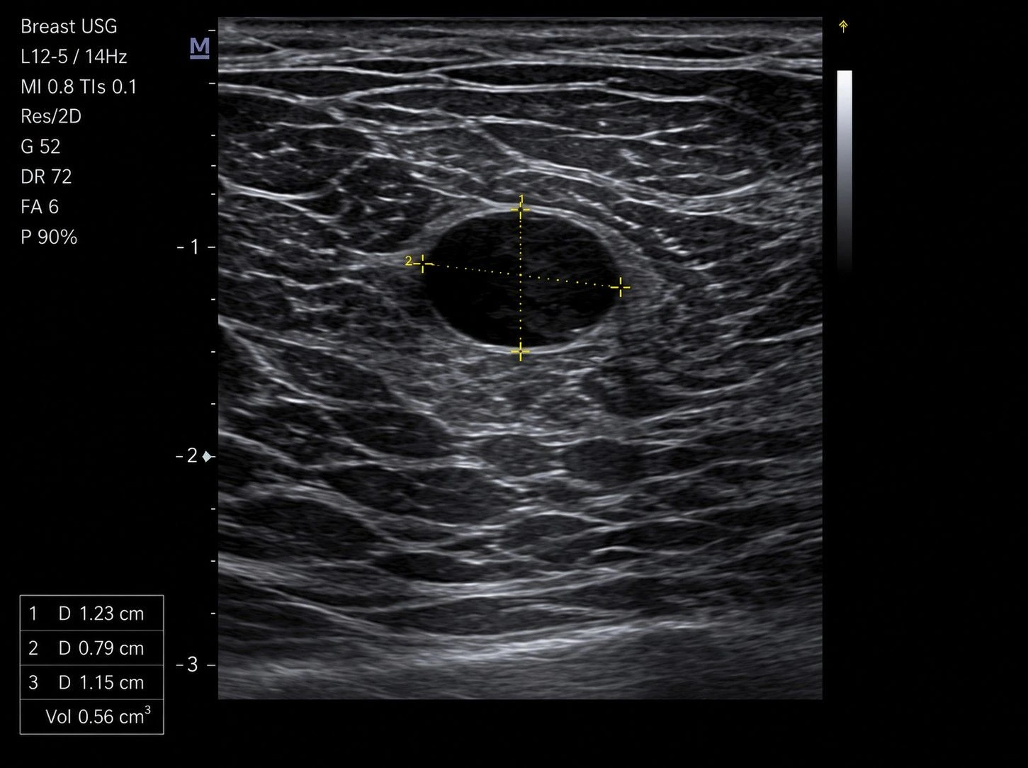USG Mammogram